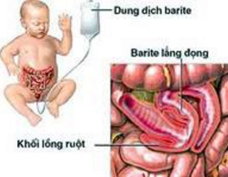 Lồng ruột xảy ra khi một đoạn ruột không ở vị trí bình thường mà “chui” vào trong lòng một đoạn ruột kế cận kèm theo là cả các mạch máu nuôi dưỡng đoạn ruột đó.